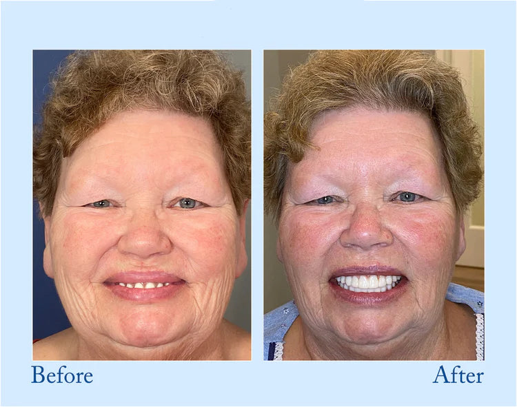 🦷Advanced Customized Full Denture Set🦷  (🔥10.000+ Sold In Last 30 Day)